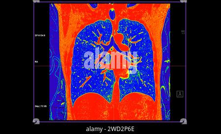 CT-Scan der koronalen Thoraxansicht im Farbmodus für diagnostische Lungenembolie (PE), Lungenkrebs und covid-19. Stockfoto