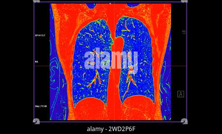 CT-Scan der koronalen Thoraxansicht im Farbmodus für diagnostische Lungenembolie (PE), Lungenkrebs und covid-19. Stockfoto