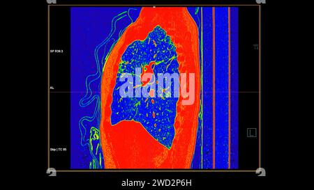 CT-Scan der sagittalen Thoraxansicht im Farbmodus für diagnostische Lungenembolie (PE), Lungenkrebs und covid-19. Stockfoto