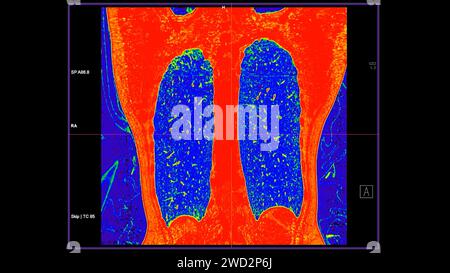 CT-Scan der koronalen Thoraxansicht im Farbmodus für diagnostische Lungenembolie (PE), Lungenkrebs und covid-19. Stockfoto