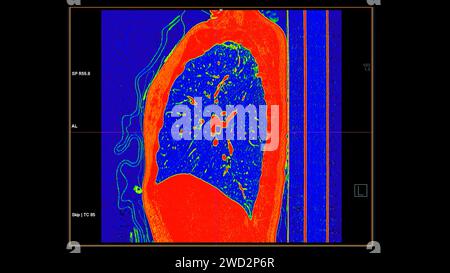 CT-Scan der sagittalen Thoraxansicht im Farbmodus für diagnostische Lungenembolie (PE), Lungenkrebs und covid-19. Stockfoto