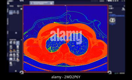 CT-Scan der Thoraxansicht im Farbmodus für diagnostische Lungenembolie (PE), Lungenkrebs und covid-19. Stockfoto