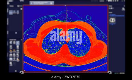 CT-Scan der Thoraxansicht im Farbmodus für diagnostische Lungenembolie (PE), Lungenkrebs und covid-19. Stockfoto