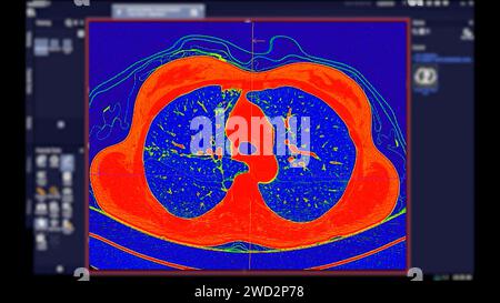 CT-Scan der Thoraxansicht im Farbmodus für diagnostische Lungenembolie (PE), Lungenkrebs und covid-19. Stockfoto