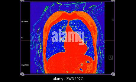 CT-Scan der koronalen Thoraxansicht im Farbmodus für diagnostische Lungenembolie (PE), Lungenkrebs und covid-19. Stockfoto