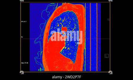 CT-Scan der koronalen Thoraxansicht im Farbmodus für diagnostische Lungenembolie (PE), Lungenkrebs und covid-19. Stockfoto