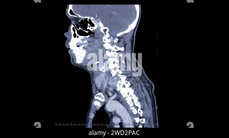 Ein CT-Scan der sagittalen Halsansicht für diagnostische Verfahren ist für die Beurteilung der Halswirbel, der Weichteile und der Erkennung von Anomalien unerlässlich Stockfoto