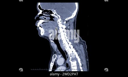 Ein CT-Scan der sagittalen Halsansicht für diagnostische Verfahren ist für die Beurteilung der Halswirbel, der Weichteile und der Erkennung von Anomalien unerlässlich Stockfoto