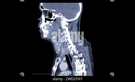 Ein CT-Scan der sagittalen Halsansicht für diagnostische Verfahren ist für die Beurteilung der Halswirbel, der Weichteile und der Erkennung von Anomalien unerlässlich Stockfoto