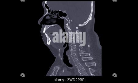 Ein CT-Scan der sagittalen Halsansicht für diagnostische Verfahren ist für die Beurteilung der Halswirbel, der Weichteile und der Erkennung von Anomalien unerlässlich Stockfoto