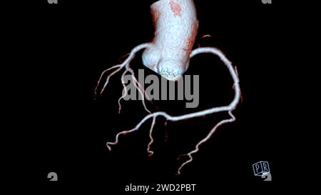 Das CTA 3D-Rendering für die Koronararterie ist eine bildgebende Diagnostik, bei der detaillierte Visualisierungen der Herzgefäße bei der Diagnose der Koronararterie erfasst werden Stockfoto