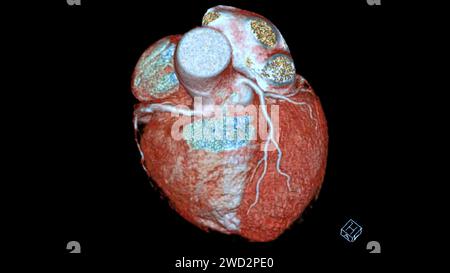 Das CTA 3D-Rendering für die Koronararterie ist eine bildgebende Diagnostik, bei der detaillierte Visualisierungen der Herzgefäße bei der Diagnose der Koronararterie erfasst werden Stockfoto