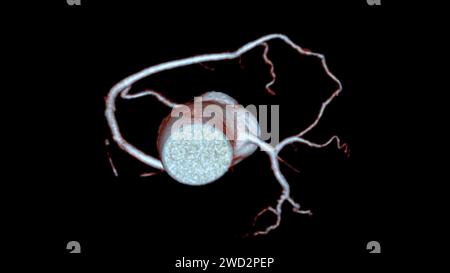 Das CTA 3D-Rendering für die Koronararterie ist eine bildgebende Diagnostik, bei der detaillierte Visualisierungen der Herzgefäße bei der Diagnose der Koronararterie erfasst werden Stockfoto