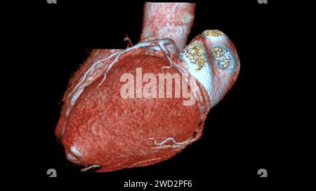 Das CTA 3D-Rendering für die Koronararterie ist eine bildgebende Diagnostik, bei der detaillierte Visualisierungen der Herzgefäße bei der Diagnose der Koronararterie erfasst werden Stockfoto