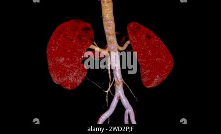 CTA renale Arteria 3D ist ein medizinisches Bildgebungsverfahren mit CT-Scans zur Untersuchung der Nierenarterien. Es liefert detaillierte Bilder der Blutgefäße Stockfoto