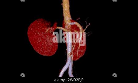 CTA renale Arteria 3D ist ein medizinisches Bildgebungsverfahren mit CT-Scans zur Untersuchung der Nierenarterien. Es liefert detaillierte Bilder der Blutgefäße Stockfoto