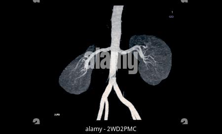 CTA renale Arteria 3D ist ein medizinisches Bildgebungsverfahren mit CT-Scans zur Untersuchung der Nierenarterien. Es liefert detaillierte Bilder der Blutgefäße Stockfoto