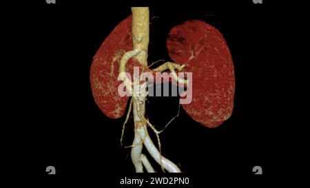 CTA renale Arteria 3D ist ein medizinisches Bildgebungsverfahren mit CT-Scans zur Untersuchung der Nierenarterien. Es liefert detaillierte Bilder der Blutgefäße Stockfoto