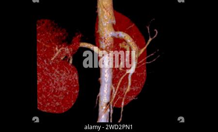 CTA renale Arteria 3D ist ein medizinisches Bildgebungsverfahren mit CT-Scans zur Untersuchung der Nierenarterien. Es liefert detaillierte Bilder der Blutgefäße Stockfoto