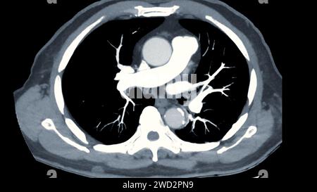 CTPA oder CTA Pulmonalarterie. Diese Bildgebungstechnik bietet eine klare Sicht auf die Pulmonalarterien und hilft bei der Diagnose einer Lungenembolie, VAS Stockfoto