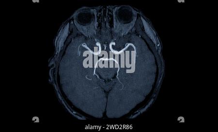 Axiale MRA-Ansicht des Gehirns bietet dieses Bildgebungsverfahren klare Visualisierungen der arteriellen und venösen Strukturen des Gehirns und unterstützt so die Diagnose von Vaskeln Stockfoto