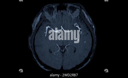 Axiale MRA-Ansicht des Gehirns bietet dieses Bildgebungsverfahren klare Visualisierungen der arteriellen und venösen Strukturen des Gehirns und unterstützt so die Diagnose von Vaskeln Stockfoto