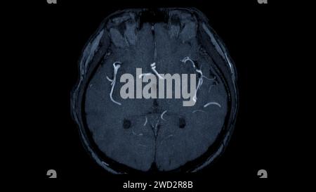 Axiale MRA-Ansicht des Gehirns bietet dieses Bildgebungsverfahren klare Visualisierungen der arteriellen und venösen Strukturen des Gehirns und unterstützt so die Diagnose von Vaskeln Stockfoto