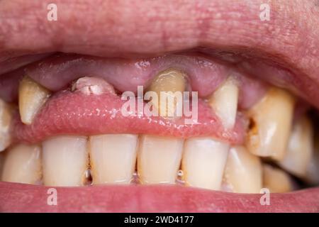Gebrochener Zahn, fehlende Zähne im offenen menschlichen Mund, Nahaufnahme Makrofoto. Zahnärztliche Probleme, zahnmedizinisches Konzept. Stockfoto