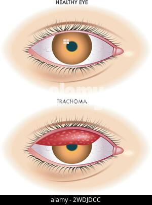 Die medizinische Illustration zeigt den Vergleich zwischen einem normalen Auge und einem von Trachom betroffenen Auge einer Infektionskrankheit, die durch das Bakterium Chlamydia trach verursacht wird Stock Vektor