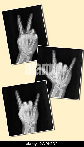 Röntgen- oder Röntgenaufnahmen einer Hand und Finger, die das groovige Zeichen des Friedens-Hippie der 1960er Jahre zeigen, oder V, I love You, Rock auf Teufelshorn. Aka Frieden, Liebe Stockfoto