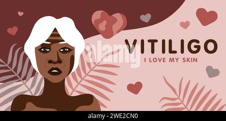 Banner über Vitilingo Hautkrankheit mit älterer afroamerikanischer Frau, minimalistische Vektor-Illustration, Text Ich liebe meine Haut Stock Vektor