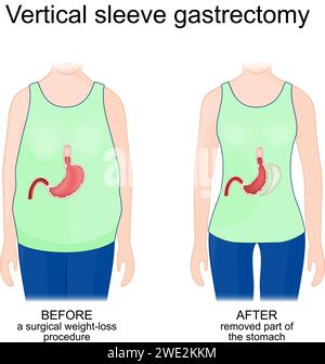 Vertikalärmel-Gastrektomie. Der menschliche Körper vor einem chirurgischen Gewichtsabnahmeverfahren und nach Entfernung des Magens. Vektorabbildung Stock Vektor