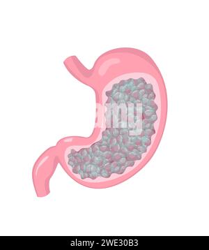 Magen mit Gas und Blähungen. Pathologie der inneren Organstörung des Menschen. Stock Vektor