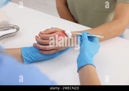 Arzt, der die verbrannte Hand des Patienten am Tisch behandelt, Nahaufnahme Stockfoto