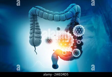 Darmkrebs, Bakterien, Viren im kranken ungesunden Darm. 3D-Abbildung Stockfoto