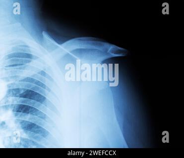Röntgenbild einer Oberarmkopf-Schulterluxation. Die Klavikulafraktur. Traumatologie und Orthopädie. Stockfoto