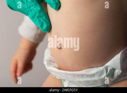 Ärzte Hände in grünen medizinischen Handschuhen untersuchen eine Nabelhernie bei einem Kind, Nahaufnahme. Probleme Stockfoto