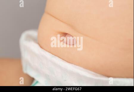 Nabelhernie bei einem Neugeborenen am Magen. Behandlung von Nabelhernien bei Kindern ohne Operation, medizinisch Stockfoto