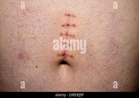 Sicht auf eine heilende Naht am prallenden Bauch eines Mannes. Stockfoto