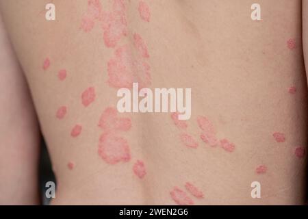 Psoriasis vulgaris, Hautflecken sind in der Regel rot, juckend und schuppig. Stockfoto