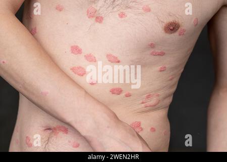 Psoriasis vulgaris, Hautflecken sind in der Regel rot, juckend und schuppig. Stockfoto