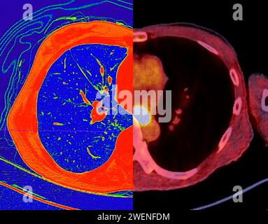 CT-Scan der Thoraxansicht im Farbmodus für diagnostische Lungenembolie (PE), Lungenkrebs und covid-19. Stockfoto