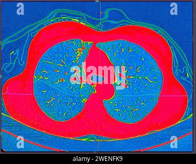 CT-Scan der Thoraxansicht im Farbmodus für diagnostische Lungenembolie (PE), Lungenkrebs und covid-19. Stockfoto