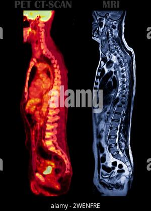 Ein PET-CT-Scan-Bild und MRT-Screening der gesamten Wirbelsäule sagittale Ansicht. Stockfoto