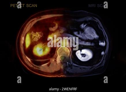 Ein PET-CT-Scan-Bild und MRT-Abdomen. Stockfoto