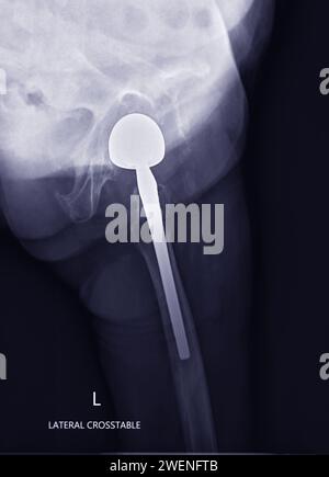 Ein Röntgenbild zeigt beide Hüftgelenke mit HÜFTGELENKTOTALENDOPROTHETIK, zeigt den Erfolg des chirurgischen Eingriffs und liefert einen visuellen Nachweis für den Stockfoto