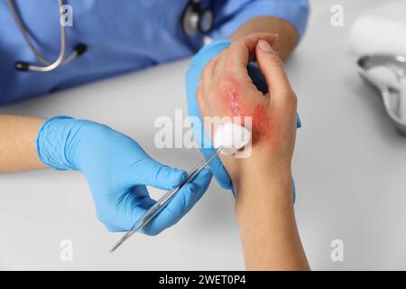 Arzt, der die verbrannte Hand des Patienten am Tisch behandelt, Nahaufnahme Stockfoto