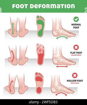 Fussdeformation. Fußpathologie Infografiken, normale Position, flache und hohle Füße, Fußgewölbe, Lehrplan, orthopädisches medizinisches Poster Stock Vektor