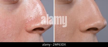 Mitesser-Behandlung, vor und nach. Collage mit Fotos der Frau auf grauem Hintergrund, Nahaufnahme Stockfoto