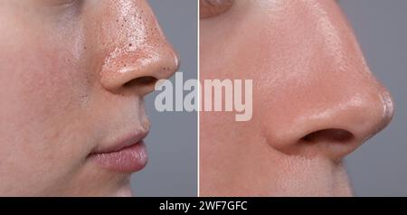 Mitesser-Behandlung, vor und nach. Collage mit Fotos der Frau auf grauem Hintergrund, Nahaufnahme Stockfoto